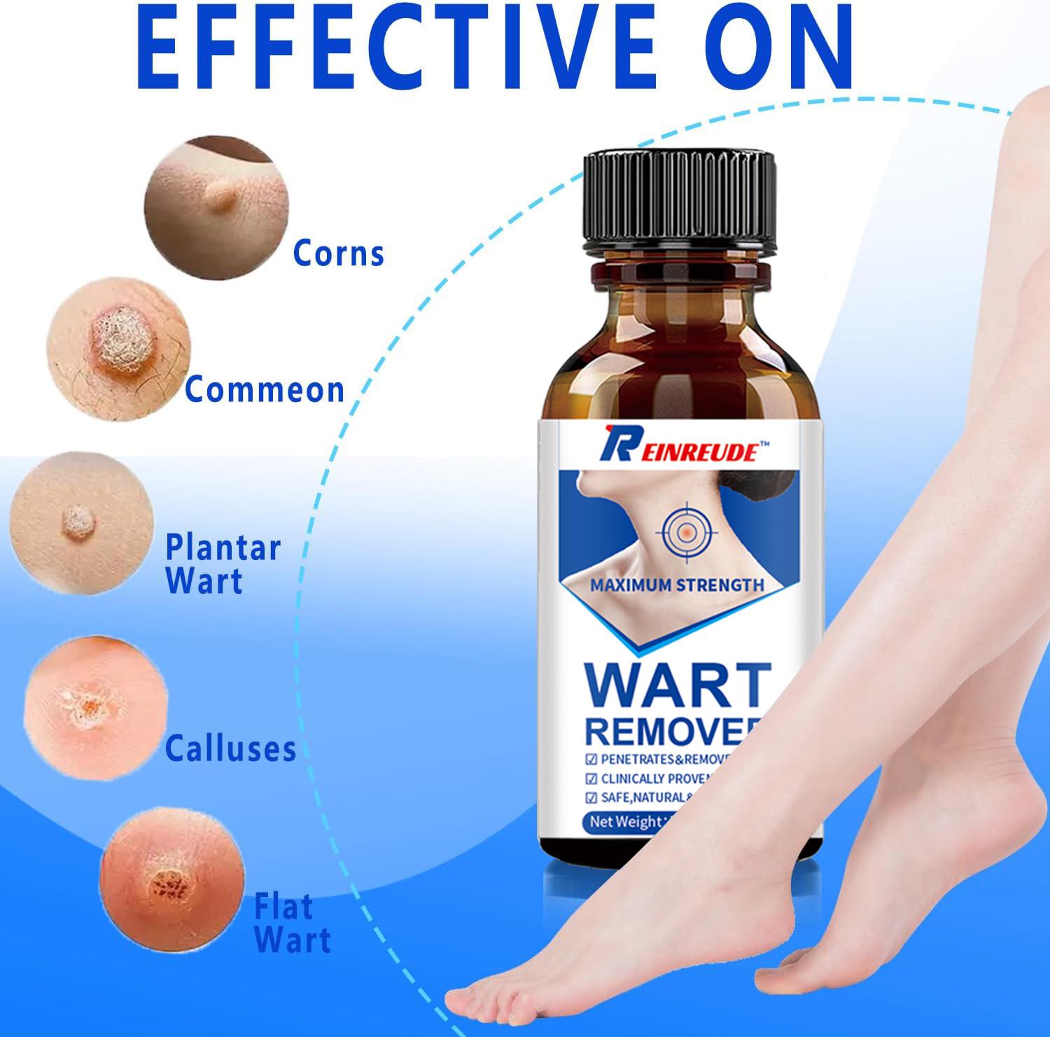 Skin Tag Removal Kit - 30ml at-Home Skin Tag Remover - 17% Salicylic Acid Wart Remover Freeze Off, Fast-Acting on Plantar Warts, Common Wart, Flat Wart, Corns and Genital Warts(-1