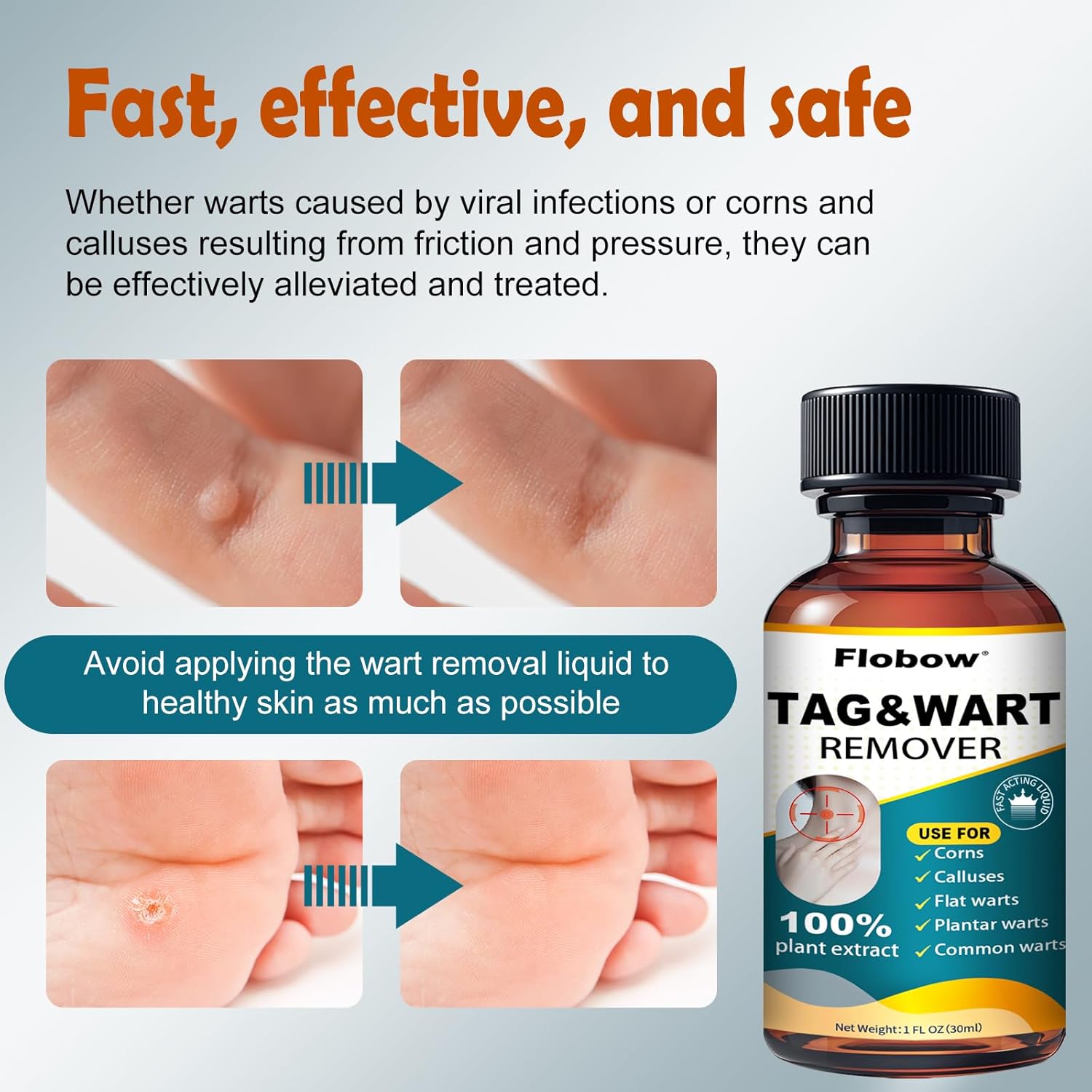 Skin Tag Removal Kit - Fast-Acting Wart Liquid with 17% Salicylic Acid for Men and Women, Targets Plantar Warts, Flat Warts, Common Warts, Age Spots, Corns, and H-Warts (30ml)