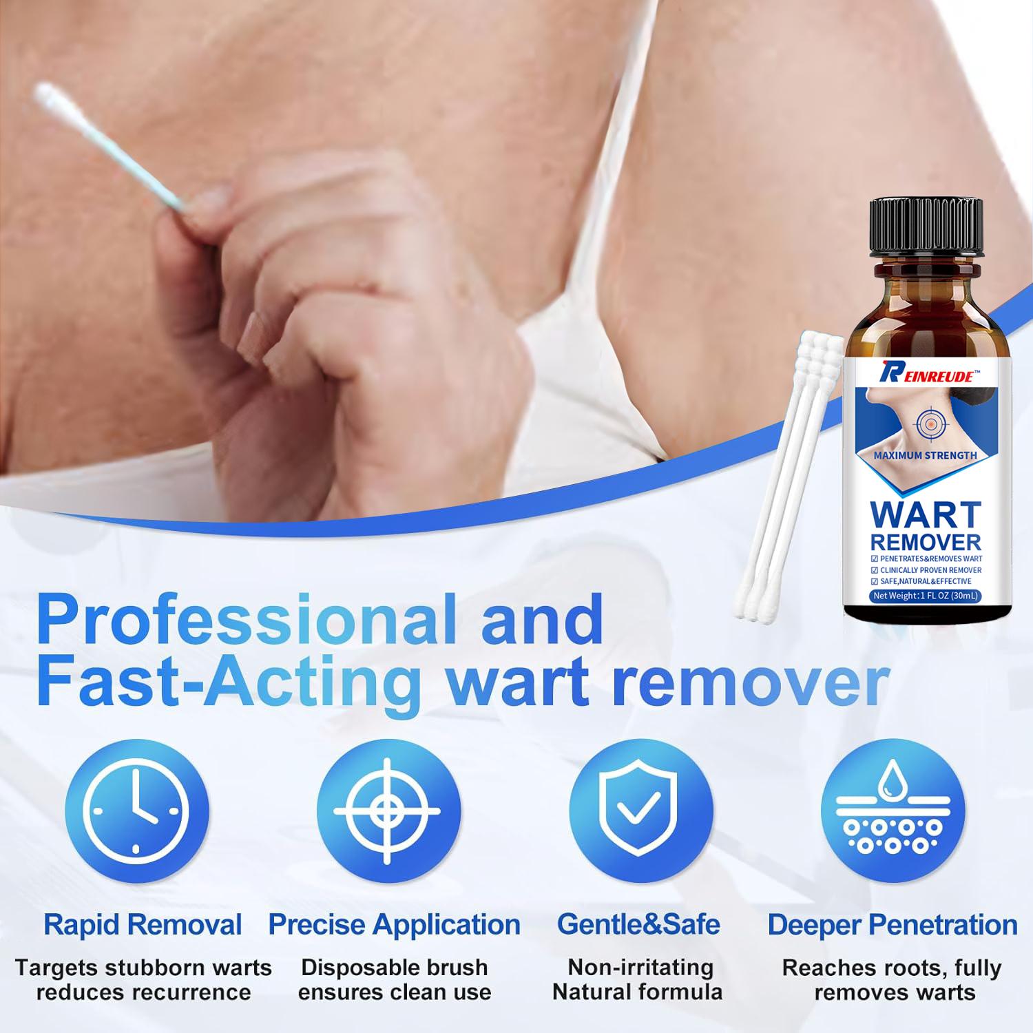 Skin Tag Removal Kit - 30ml at-Home Skin Tag Remover - 17% Salicylic Acid Wart Remover Freeze Off, Fast-Acting on Plantar Warts, Common Wart, Flat Wart, Corns and Genital Warts(-1